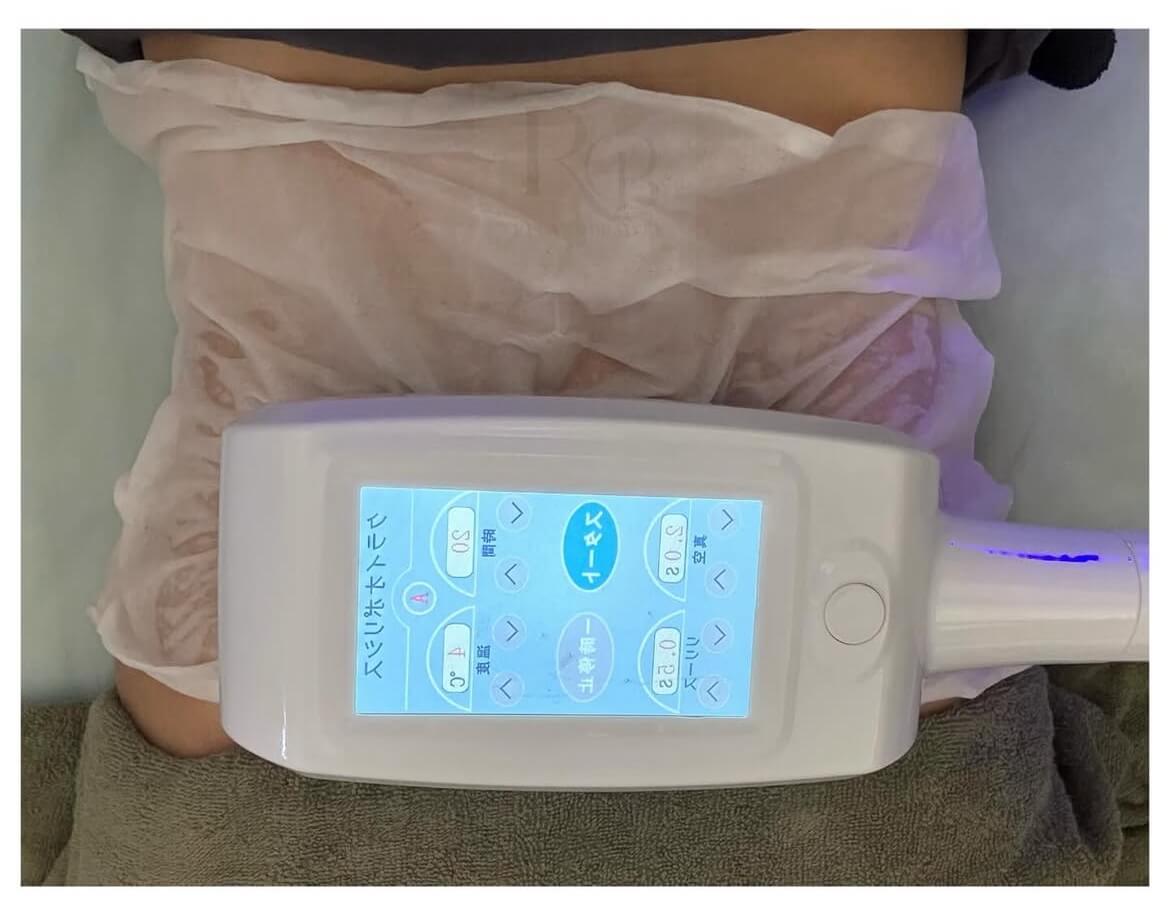 3D脂肪冷却（お腹・太もも等）